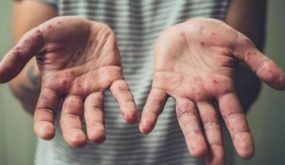 جدري القرود يصل البحرين